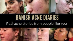 'THIS IS MY ACNE STORY - BANISH ACNE DIARIES'