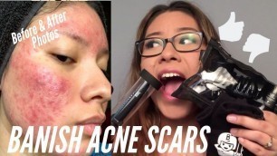 'BANISH ACNE SCARS Review + Photo Progress'