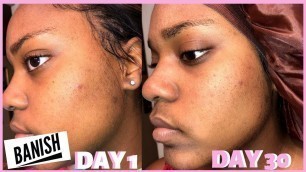 'I TRIED USING BANISH ACNE SCARS FOR 30 DAYS | DOES BANISH WORK ON DARK SKIN?'