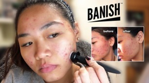 'Banish Acne Scars Review (4 weeks)'