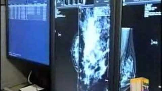 'Digital Mammography'