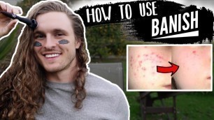 'HOW TO GET RID OF ACNE SCARS AT HOME (BANISH)'