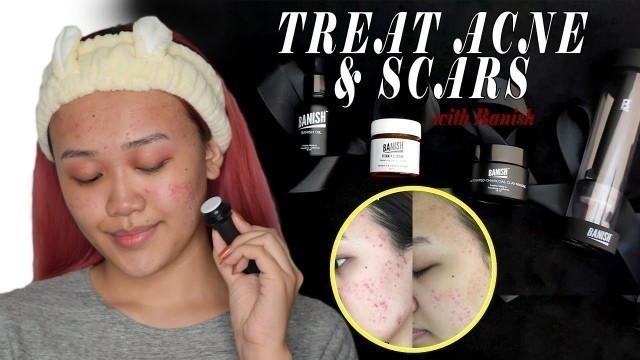 'BANISH ACNE SCARS REVIEW'