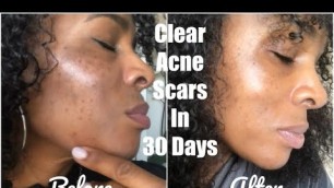 'HOW TO CLEAR ACNE SCARRING WITH BANISH IN 30 DAYS! | MICRO DERMA NEEDLING |  Mel\'s World'