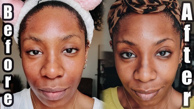 'Banish Acne Scars & Hyperpigmentation : Microneedling At Home | NaturallyNellzy'