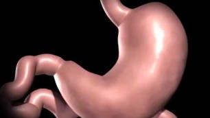 'Baptist Health Paducah Sleeve Gastrectomy Animation'