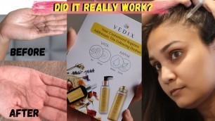 'Vedix Products Honest Review - A Customized Hair Care Regimen | Reduce Hairfall | Nidhi Katiyar'