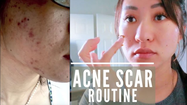 'Skincare Routine for Acne Scars Using Banish Starter Kit'