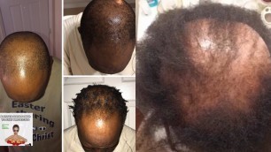 'USE THIS NATURAL PRODUCT TO STOP HAIR LOSS AND GROW HAIR FAST'