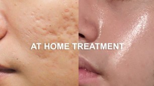 'How To Fix Face Scars FAST | At Home Quarantine Makeover'