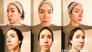 'Banish Rosacea and Acne // 1 Month Full Product Review + Demo'