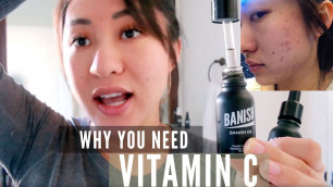 'Why This Vitamin C Serum Is Great For Acne Scars - Banish Oil'